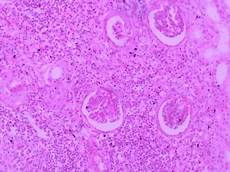 急性肾盂肾炎治疗