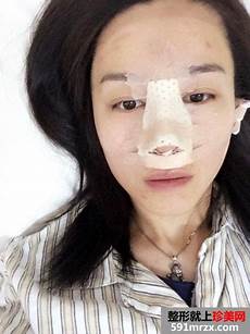 假体隆鼻手术