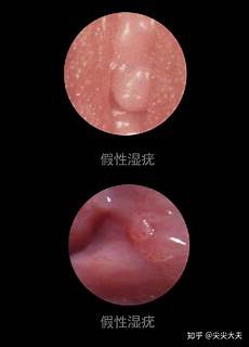 假体隆鼻手术要多少钱隆鼻手术的价格受哪些因素影响