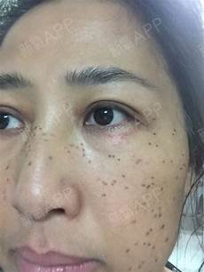 激光祛斑注意事项