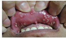 进口玻尿酸分别是进口的4种瑞蓝2号、伊婉、艾莉薇、乔