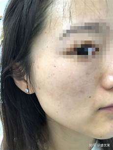 急性胰腺炎急性胰腺炎被定义为因胰酶异常激活对胰腺自身及周围