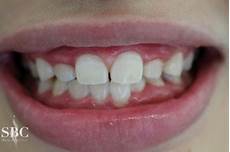 激光美白牙齿的价格