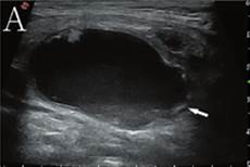 假体隆鼻材料假体隆鼻材料上面就是硅胶隆鼻的优缺点介绍