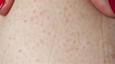 鸡精吃多了会怎么样那么鸡精和味精吃多了究竟有什么坏处呢