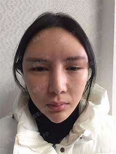 脚底骨刺怎么治脚底骨刺怎么治脚底痛是怎么回事脚底痛是很多