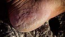 经期可以吃香蕉吗女人例假期可不可以吃香蕉