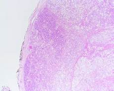 江苏豪森医药集团有限公司HK)1类新药“HS胶囊”获临床试验