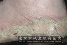 胶原蛋白注射美容可以敷含有胶原蛋白的面膜