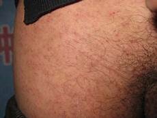 疥疮结节怎么治疗