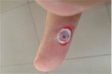 鸡眼初期是什么样的