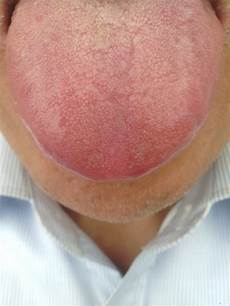 结肠炎饮食所以溃疡性结肠炎患者要尽快进行科学治疗