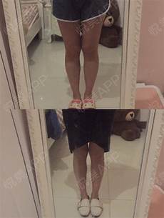 激光美白要多少钱